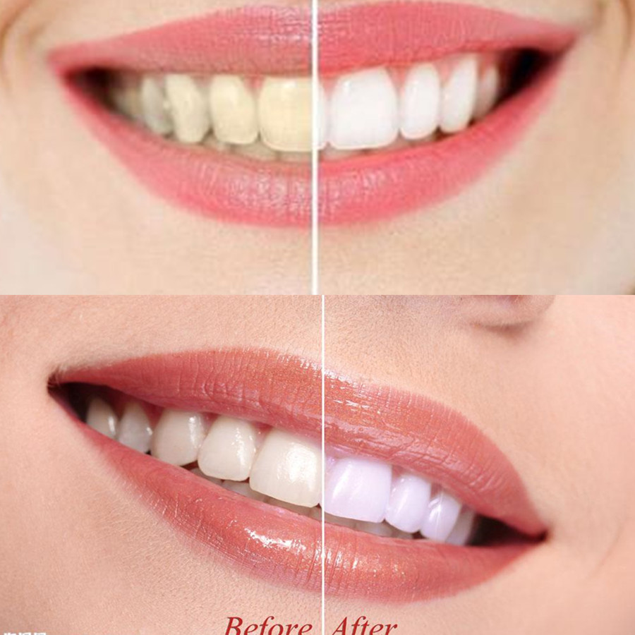 Dentes de carvão vegetal de ba - Teeth Whitening Singapore avaliação e preço