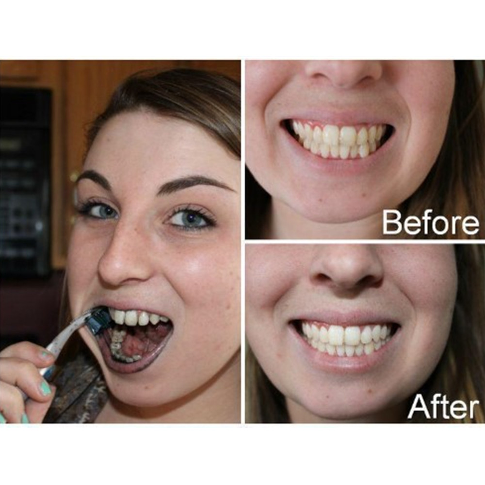 Dentes de carvão vegetal de ba - Teeth Whitening Singapore avaliação e preço