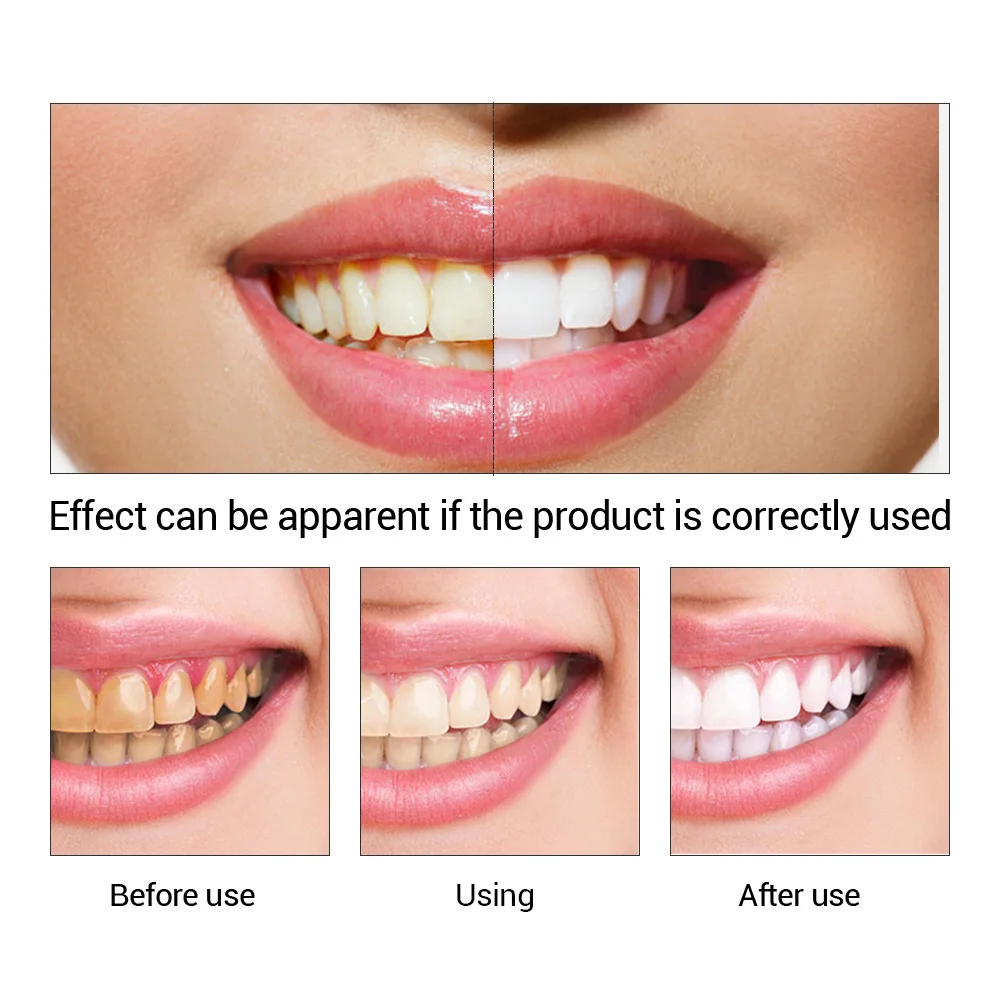 FTEENPLY Essência para claream - Teeth Whitening Singapore avaliação e preço