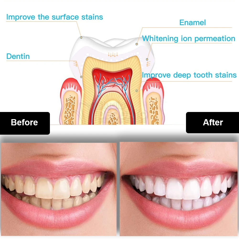 Kit de clareamento dental dos  - Teeth Whitening Singapore avaliação e preço