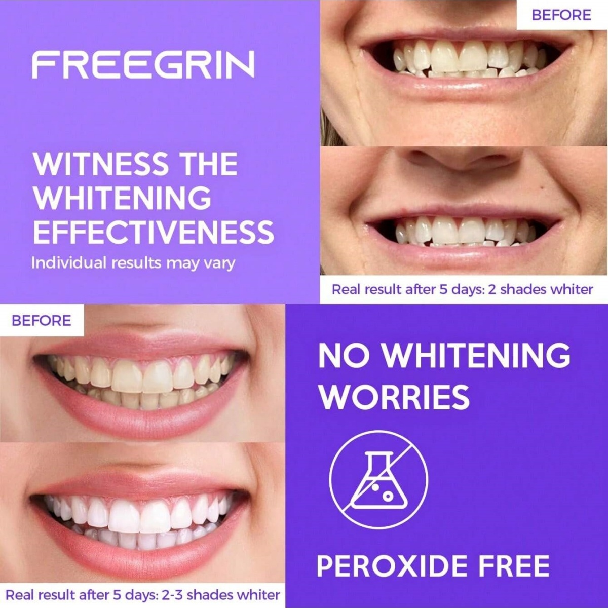 Adesivos de clareamento dental - Teeth Whitening Singapore avaliação e preço